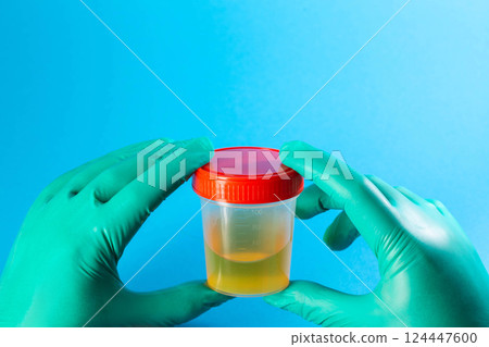 Urine analysis in the hands of a doctor laboratory assistant on a blue background. Urine tests for protein, infections and mucus. Pyelonephritis and urethritis in urology. Copy space for text 124447600