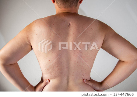 A man has a scar and red pimples on his skin due to poor hygiene. Inflammation of the sebaceous glands, close-up 124447666