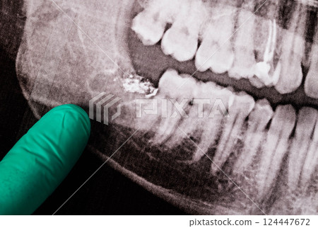 A doctor's finger in a green medical glove pointing to an x-ray with a lower wisdom tooth removed, close-up 124447672