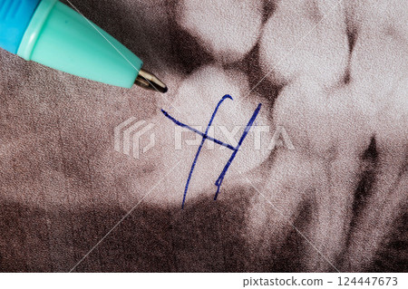 Pen and crossed out wisdom teeth on a dental x-ray, removal of wisdom teeth, close-up Pen and crossed out wisdom teeth on a dental x-ray, removal of wisdom teeth, close-up 124447673