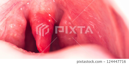 Uvulitis and sore throat in the oral cavity due to illness. Inflammation of the uvula and tonsils due to infections during illness, close-up, streptococcus. Copy space for text 124447716