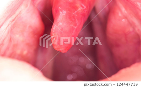 Uvulitis and sore throat in the oral cavity due to illness. Inflammation of the uvula and tonsils due to infections during illness, close-up, streptococcus. Allergy 124447719