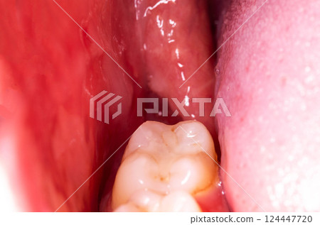 recess after complex impacted wisdom tooth extraction, traumatic healing. Dry socket, alveolitis, macro. Copy space for text recess after complex impacted wisdom tooth extraction, traumatic healing. Dry socket, alveolitis, macro. Copy space for text 124447720