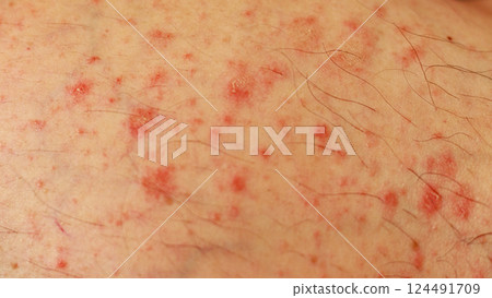 Close-up of Caucasian skin with urticarial vasculitis, rare skin condition with raised red patches and hives Close-up of Caucasian skin with urticarial vasculitis, rare skin condition with raised red patches and hives 124491709