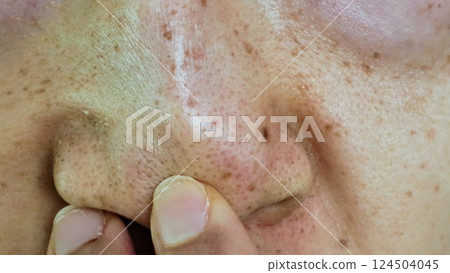 Person checking for blackheads on nose Person checking for blackheads on nose 124504045