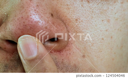 Man pointing at blackheads on his nose Man pointing at blackheads on his nose 124504046