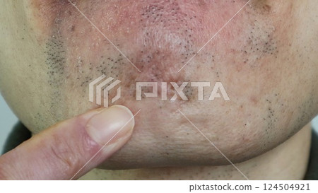 A man pointing at his thinning beard 124504921