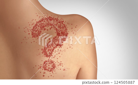 Measles Information 124505887