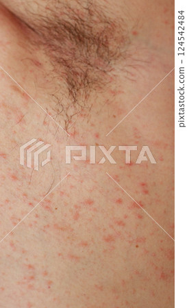Pityriasis rosea rash on caucasian skin near the armpit that usually result from an immune response or allergy Pityriasis rosea rash on caucasian skin near the armpit that usually result from an immune response or allergy 124542484