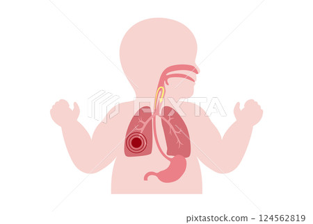 Aspiration pneumonia poster 124562819