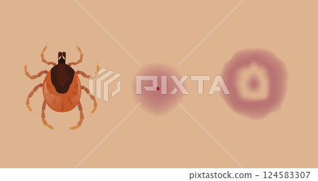 Tick biting skin causing disease and erythema migrans rash Tick biting skin causing disease and erythema migrans rash 124583307