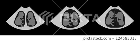 Ultrasound Showing Twin Pregnancy Development Stages 124583315