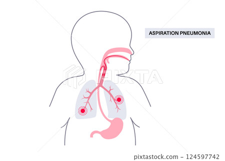 Aspiration pneumonia poster 124597742