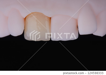 Mirror copy of central maxillary incisor, ultra thin dental ceramic veneer or crown on printed model Mirror copy of central maxillary incisor, ultra thin dental ceramic veneer or crown on printed model 124598333