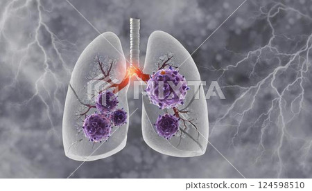 香菸煙霧引起的肺癌、癌細胞增生和轉移的 3D 圖示 香菸煙霧引起的肺癌、癌細胞增生和轉移的 3D 圖示 124598510