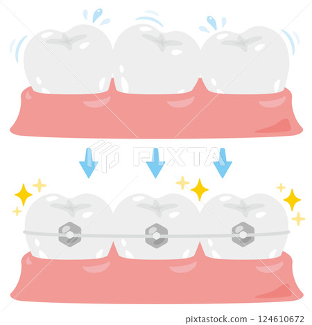 Illustration set of misaligned teeth and corrected teeth Illustration set of misaligned teeth and corrected teeth 124610672