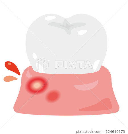 患有口腔炎的牙齦圖示 患有口腔炎的牙齦圖示 124610673