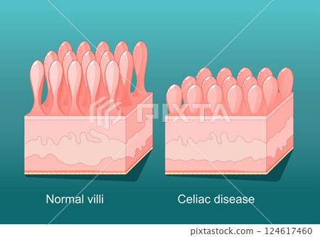 Coeliac disease. celiac disease. Gluten intolerance 124617460