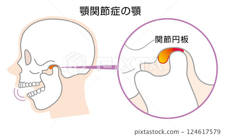 顳顎關節障礙的顎骨圖示 124617579