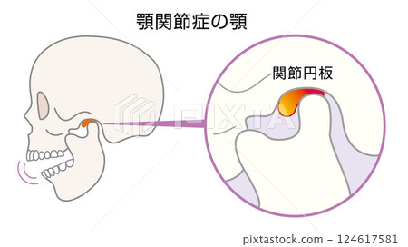 顳顎關節障礙的顎骨圖示 顳顎關節障礙的顎骨圖示 124617581