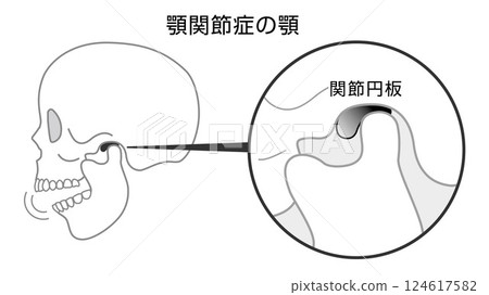 顳顎關節障礙患者的顎骨單調圖示 124617582