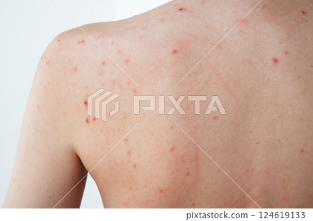 female back and shoulders of a woman with pimples and acne on skin. The body of girl with problematic skin close-up 124619133