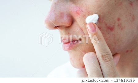 young woman applies acne cream on face with pimples and blackheads. Teenage girl with problematic skin in close-up on an isolated white background 124619189