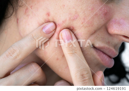 young woman presses acne and pimples on the skin on female face with fingers. Teenager girl with problematic skin close-up young woman presses acne and pimples on the skin on female face with fingers. Teenager girl with problematic skin close-up 124619191