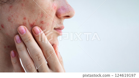 female face with acne and pimples on problem skin closeup on isolated white background female face with acne and pimples on problem skin closeup on isolated white background 124619197