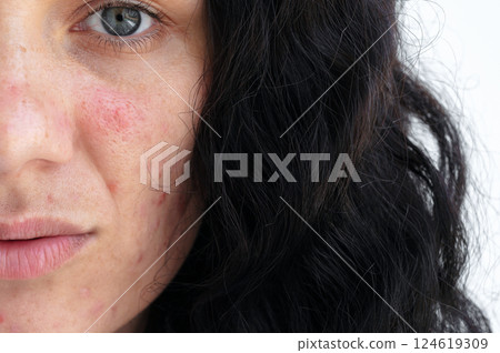 female face of a young woman with acne and pimples on problematic skin is a close-up female face of a young woman with acne and pimples on problematic skin is a close-up 124619309