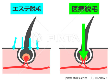 美容院和醫療機構如何從根部去除毛髮以實現美麗肌膚的橫截面視圖 美容院和醫療機構如何從根部去除毛髮以實現美麗肌膚的橫截面視圖 124620875