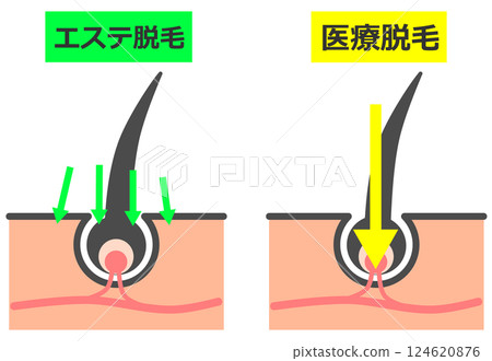 美容院和醫療機構如何從根部去除毛髮以實現美麗肌膚的橫截面視圖 美容院和醫療機構如何從根部去除毛髮以實現美麗肌膚的橫截面視圖 124620876