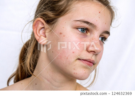 Teenage girl with acne problem on a white background, close-up. AI image. 124632369