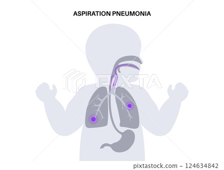 Aspiration pneumonia poster 124634842