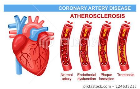 Coronary artery disease, arterial atherosclerosis, heart attack, block blood vessel cholesterol plaque. Cardiac cardiovascular system thrombosis cardiology illness. Human cardio muscle health. Vector 124635215