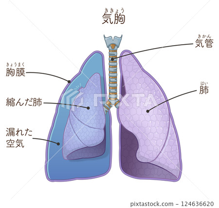 Illustration of lungs, trachea and pneumothorax 124636620