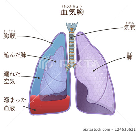 Illustration of lungs, trachea and hemopneumothorax 124636621