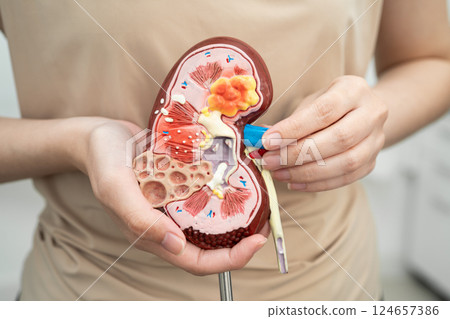 Chronic kidney disease, Asian woman with model for treatment urinary system, urology, Estimated glomerular filtration rate eGFR. Chronic kidney disease, Asian woman with model for treatment urinary system, urology, Estimated glomerular filtration rate eGFR. 124657386