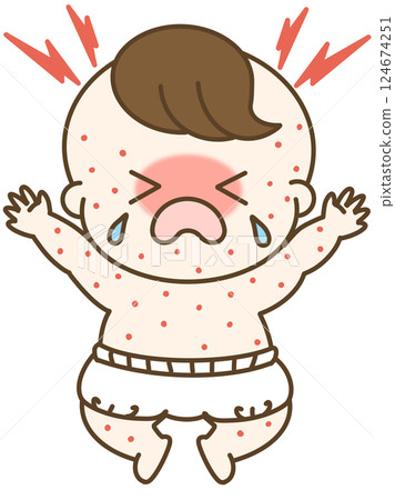 A cute illustration of a crying baby boy in a diaper with a rash 124674251