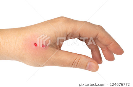 Snake bite on skin, snakebite or cat bite marks close up. Two small fresh blood drops on hand 124676772