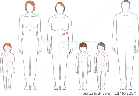 帶狀皰疹和水痘。兒童和成人症狀說明 124678297