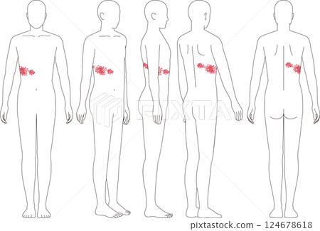 帶狀皰疹症狀。人體正面、側面和背面插圖 124678618
