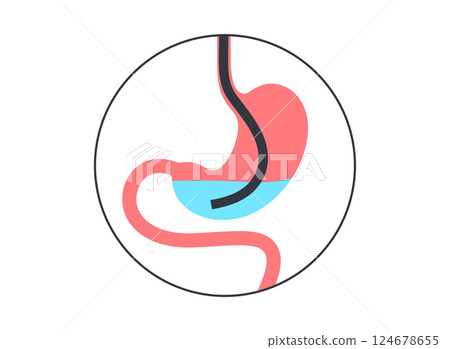 Stomach wash gastric lavage 124678655