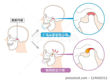 顳顎關節障礙症狀及解釋圖 124688312