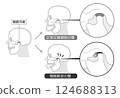顳顎關節障礙的症狀和解釋的單調插圖 顳顎關節障礙的症狀和解釋的單調插圖 124688313