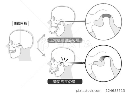 顳顎關節障礙的症狀和解釋的單調插圖 124688313