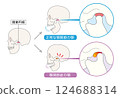 顳顎關節障礙症狀及解釋圖 顳顎關節障礙症狀及解釋圖 124688314