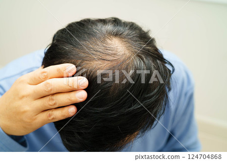 Bald head in man, hair loss treatment health problem. Bald head in man, hair loss treatment health problem. 124704868