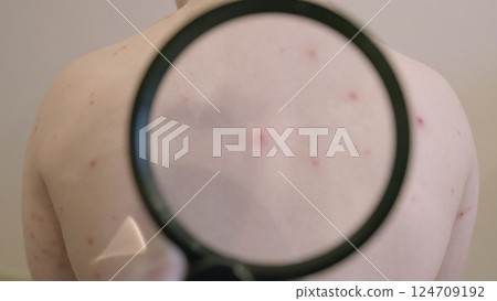 Skin Condition chickenpox That Presents with Red Spots Located on the Back Area of the Body 124709192