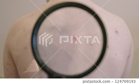 A skin condition chickenpox is clearly showcased on the back of a persons body and its appearance 124709193